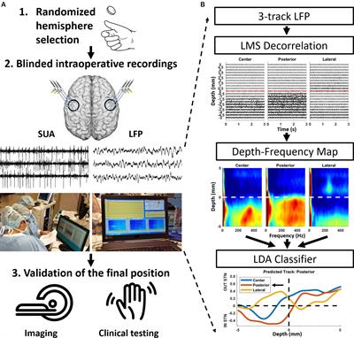 Randomized, Double-Blind Assessment of LFP Versus SUA Guidance in STN-DBS Lead Implantation: A Pilot Study